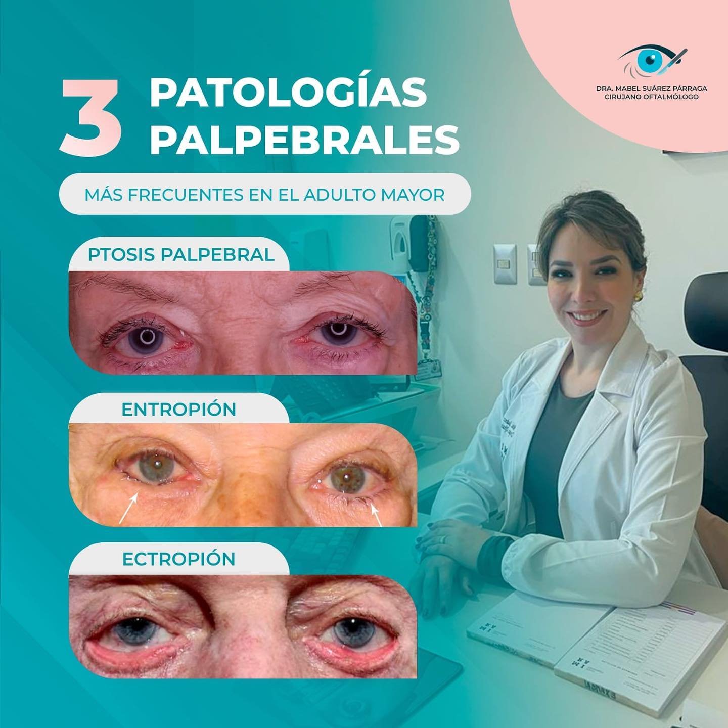 3 patologías palpebrales más frecuentes en el adulto mayor