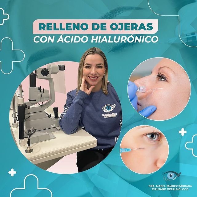 Relleno de ojeras con ácido hialurónico